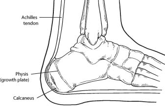 Sever’s Disease (Pediatric Heel Pain)